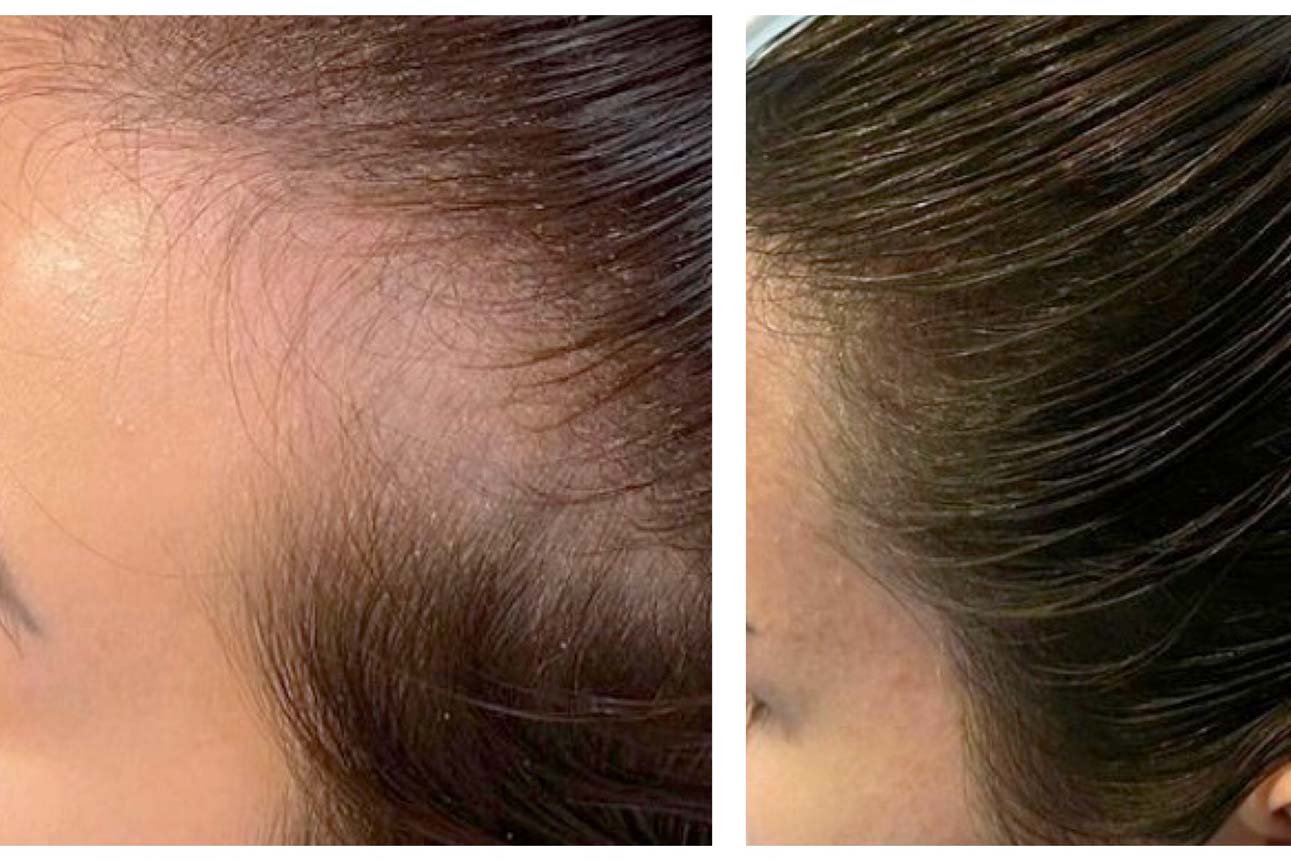 Hairgrowth complexion treatment